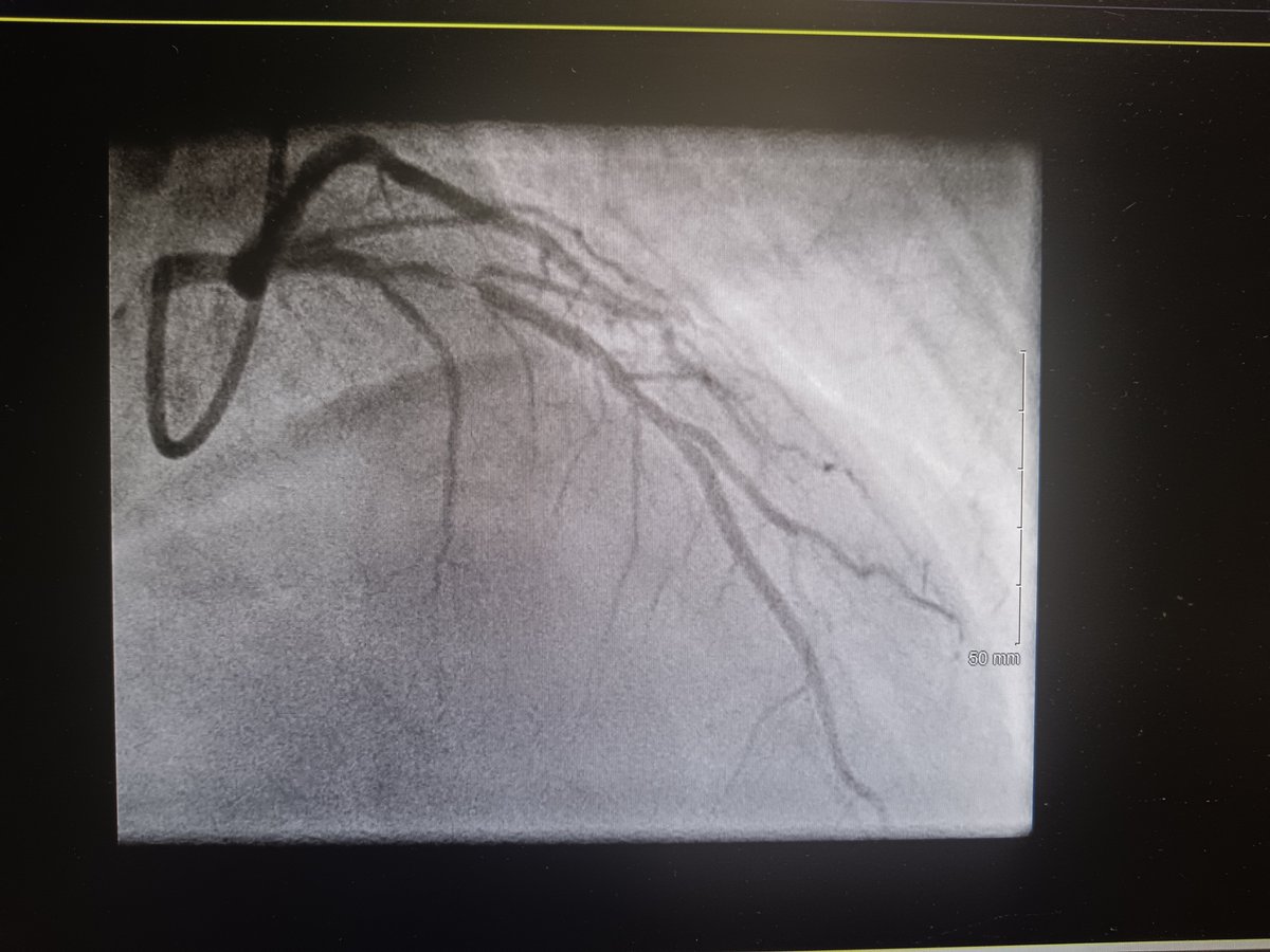 Atrial_Flutter's tweet photo. @Ecgloverr @BerkBmf @FrdBjk112 @lila_enis @MertAvsever @marioalrb84_a @DrJNELLY95 @nihar_nayak2 @Nikhil_Kr16 @ThaierT13525 @MiguelP23970914 @sohrab1104 @ghwamasoob @praneet_manekar @Drakhil_cardio @Amhar_47 @drpankajroyal https://t.co/h12p8nmork