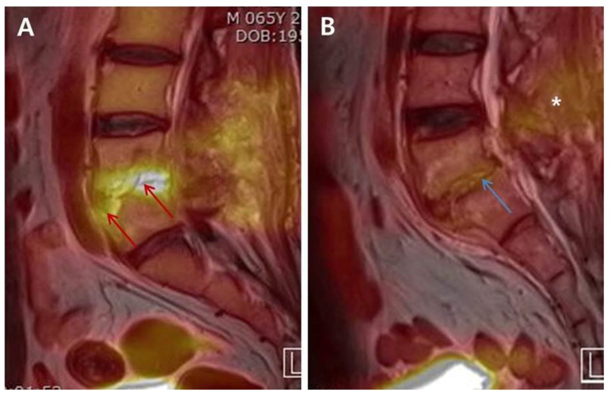 SeeFisch's tweet photo. It is VERY disappointing that Orthopedic Surgeons and Neurosurgeons cannot understand that you should NOT treat osteomyelitis empirically without a microbiological diagnosis.

Biopsy
Get a SPECIFIC organism https://t.co/8aVrFjSQKR
