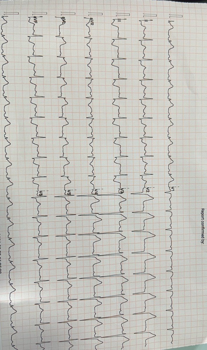 Moabo23461's tweet photo. South African flag sign

Acute high lateral STEMI https://t.co/oe0rHmDEQz