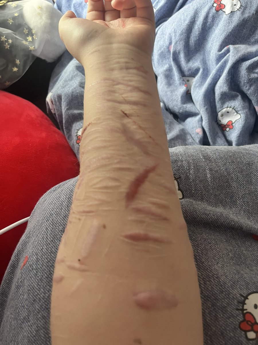bl00dfilldbaths's tweet photo. Theres lit no other place to cut, i wish scars wasnt real i js wanna cut somewhere but theres not enough space (this is all fake) #shtwt https://t.co/wjRwJFgZtO