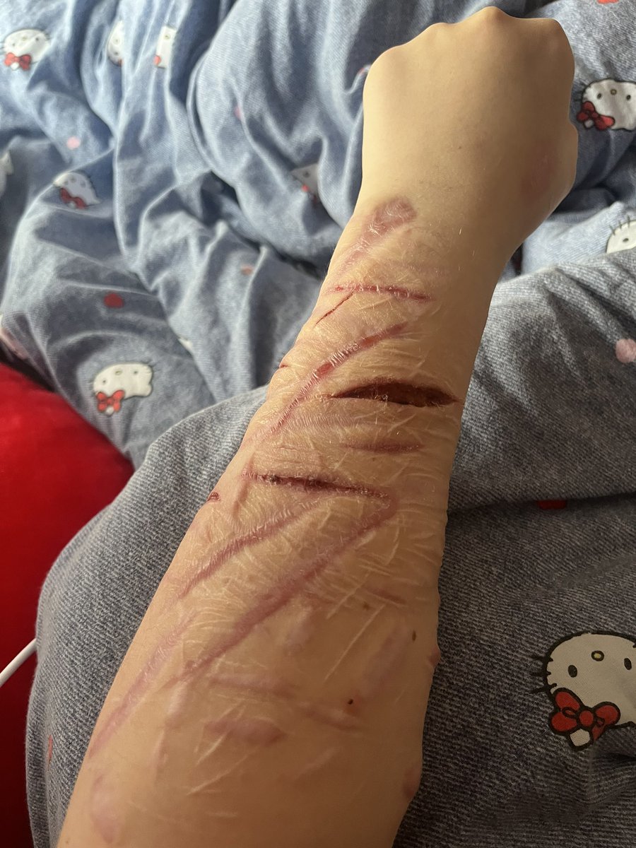 bl00dfilldbaths's tweet photo. Theres lit no other place to cut, i wish scars wasnt real i js wanna cut somewhere but theres not enough space (this is all fake) #shtwt https://t.co/wjRwJFgZtO