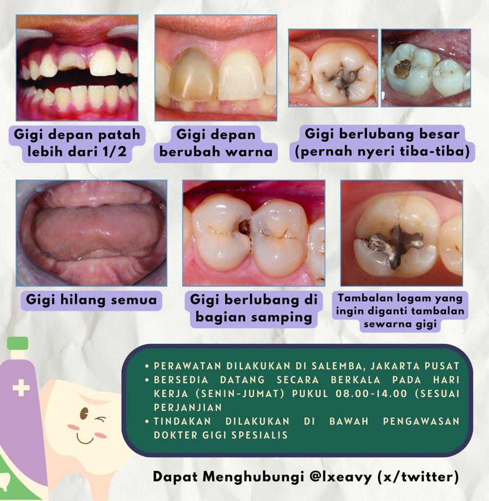 lxeavy's tweet photo. @leepeboy Lebih baik sakit hati daripada sakit gigi!! Halo, saya sedang mencari pasien gigi patah/gigi bolong/gigi palsu di jakarta pusat seperti gambar. Silakan dm bila berkenan untuk konsultasi lebih lanjut😊🙏🏻 #gigibolong #koasgigi #caripasien #sakitgigi #psa #gigipalsu #zonauang #fff https://t.co/MNkGsxzQmF