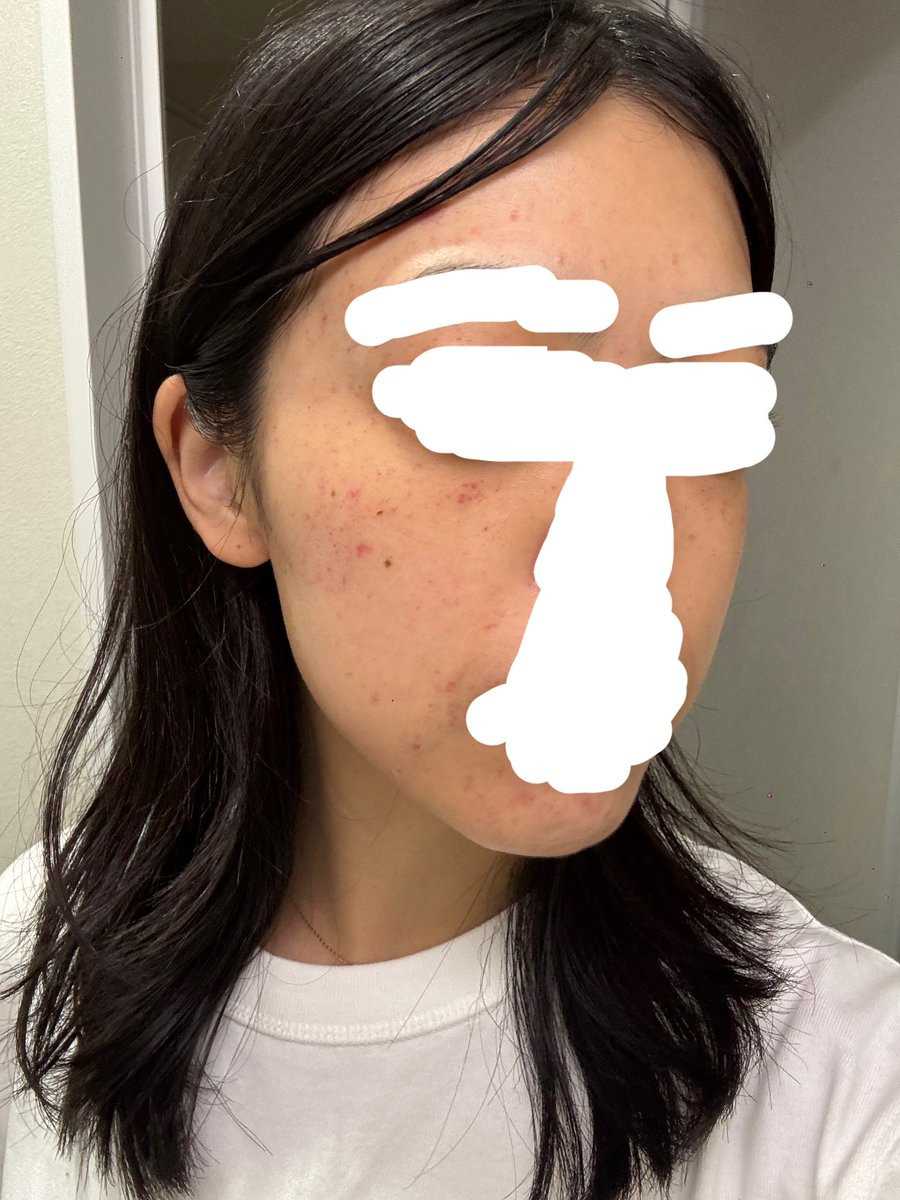 tuki_dayon's tweet photo. 髪ボサボサなのは置いといて、やばくないですか（ ;  ; ）？？
首絞めされるとみんなこんな感じになるの？それともされすぎ？相手が下手？
もーーー明日から普通に仕事なのにめちゃくちゃ萎える、、、（ ;  ; ）（ ;  ; ） https://t.co/guCW2Ye0kf