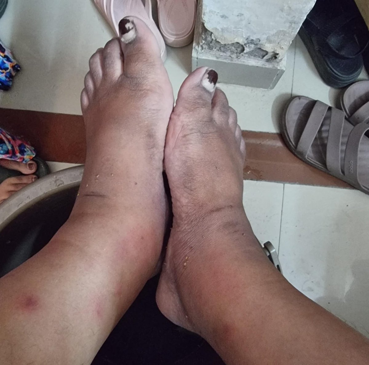 DstDhananjay's tweet photo. Toxicity in medical residency is so normalised that even when a resident’s legs are swollen, bandaged, and he’s dealing with cellulitis, the response isn’t concern~
it’s “take 1–2 hours of rest and get back to work.”

My friend from another medical college sent me this picture.

This is what residency has become: 
your body can break, your health can deteriorate, but the duty roster must never be disturbed.

We have somehow turned suffering into a qualification.

“Our college has worse shifts.”
“We survived it, so you can too.”
“Just 1–2 hours of rest.”
“Patients come first.”

No. This isn’t dedication. 
This is institutionalised exploitation disguised as medical training.

And the worst part? 
The seniors and consultants who have the authority to stop it often become so desensitised that a resident literally collapsing in front of them is treated as an inconvenience to the schedule.

A doctor’s suffering should never be the price of becoming a doctor.