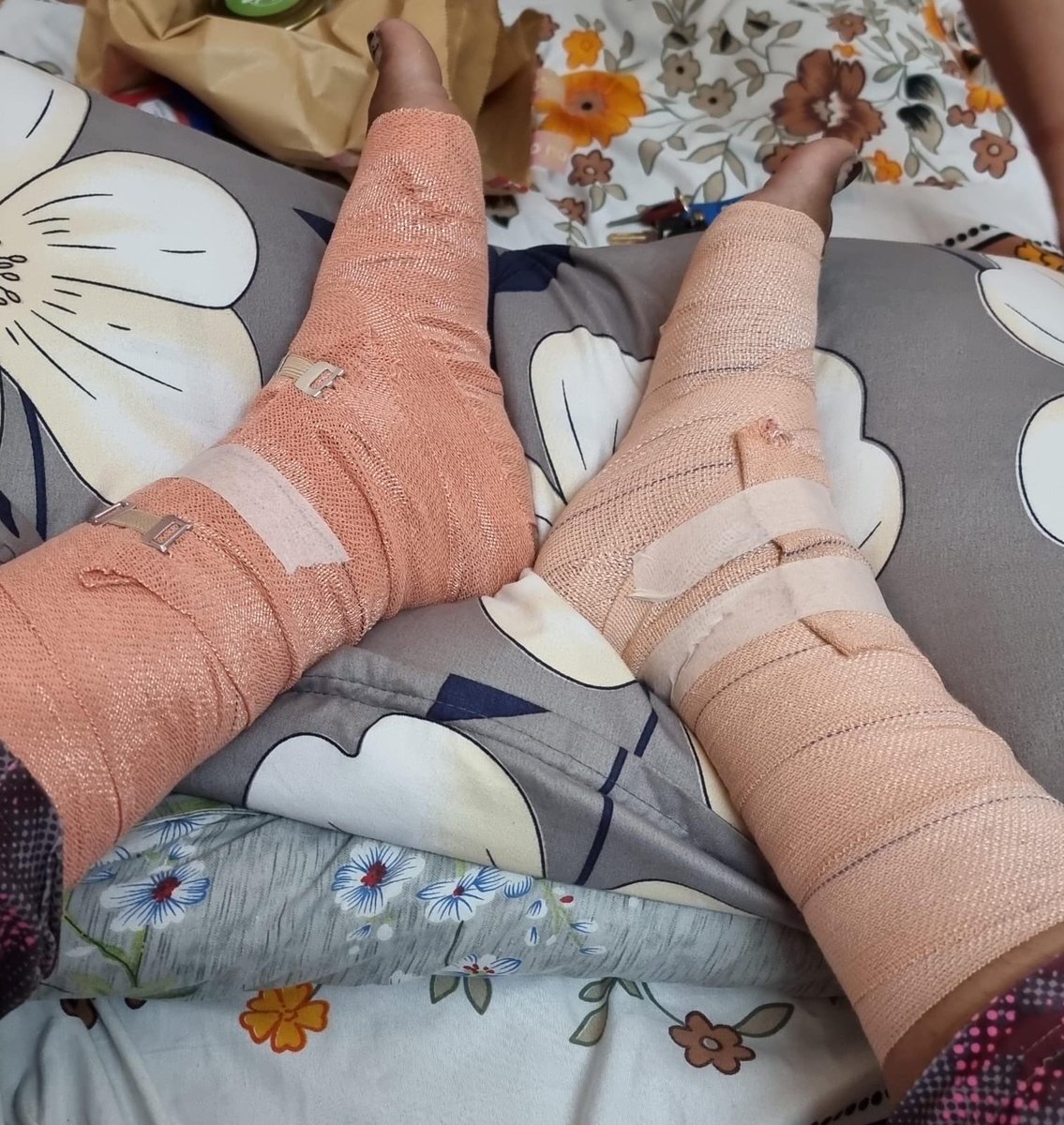 DstDhananjay's tweet photo. Toxicity in medical residency is so normalised that even when a resident’s legs are swollen, bandaged, and he’s dealing with cellulitis, the response isn’t concern~
it’s “take 1–2 hours of rest and get back to work.”

My friend from another medical college sent me this picture.

This is what residency has become: 
your body can break, your health can deteriorate, but the duty roster must never be disturbed.

We have somehow turned suffering into a qualification.

“Our college has worse shifts.”
“We survived it, so you can too.”
“Just 1–2 hours of rest.”
“Patients come first.”

No. This isn’t dedication. 
This is institutionalised exploitation disguised as medical training.

And the worst part? 
The seniors and consultants who have the authority to stop it often become so desensitised that a resident literally collapsing in front of them is treated as an inconvenience to the schedule.

A doctor’s suffering should never be the price of becoming a doctor.