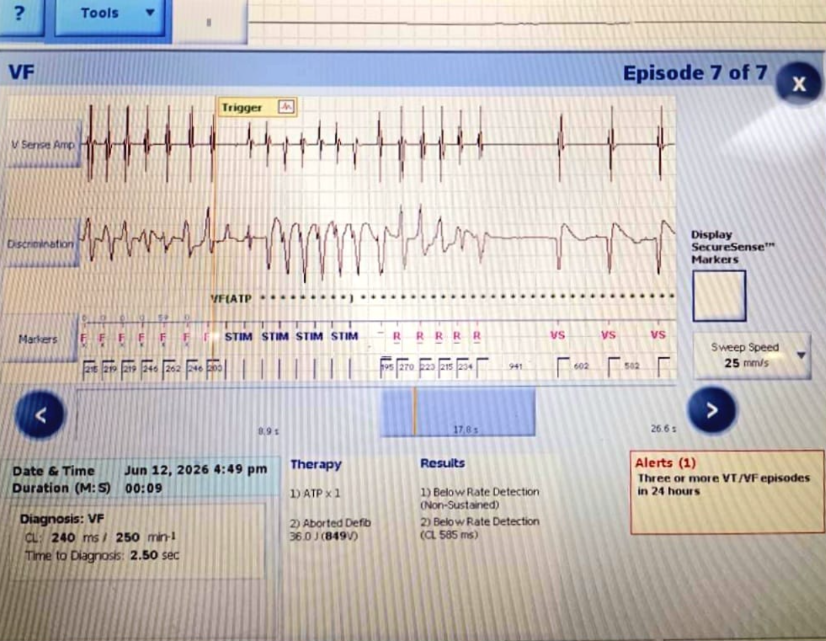 aparna_jaswal's tweet photo. A few seconds. One chaotic rhythm. One life-saving decision.

🫀VF strikes—and the ICD recognizes the danger before we can.

Rapid detection. Appropriate therapy. No room for delay.

Every EGM tells a story : )

#Cardiology #EP #ICD #draparnjaswal #EGM #VentricularFibrillation https://t.co/ar4QPV4WN8