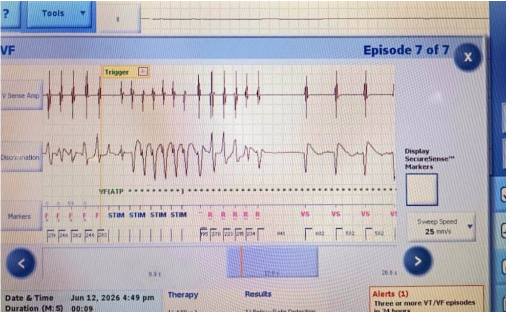 aparna_jaswal's tweet photo. A few seconds. One chaotic rhythm. One life-saving decision.

🫀VF strikes—and the ICD recognizes the danger before we can.

Rapid detection. Appropriate therapy. No room for delay.

Every EGM tells a story : )

#Cardiology #EP #ICD #draparnjaswal #EGM #VentricularFibrillation https://t.co/ar4QPV4WN8