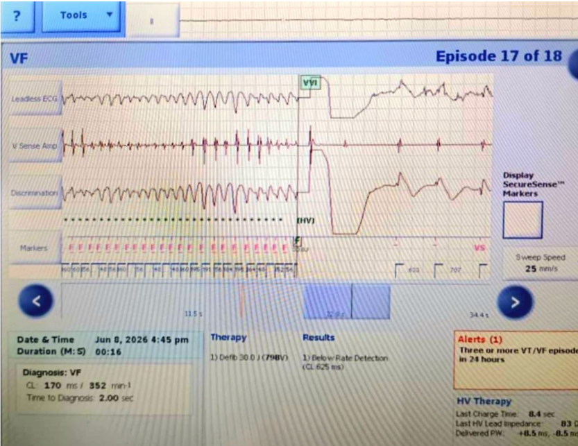aparna_jaswal's tweet photo. A few seconds. One chaotic rhythm. One life-saving decision.

🫀VF strikes—and the ICD recognizes the danger before we can.

Rapid detection. Appropriate therapy. No room for delay.

Every EGM tells a story : )

#Cardiology #EP #ICD #draparnjaswal #EGM #VentricularFibrillation https://t.co/ar4QPV4WN8