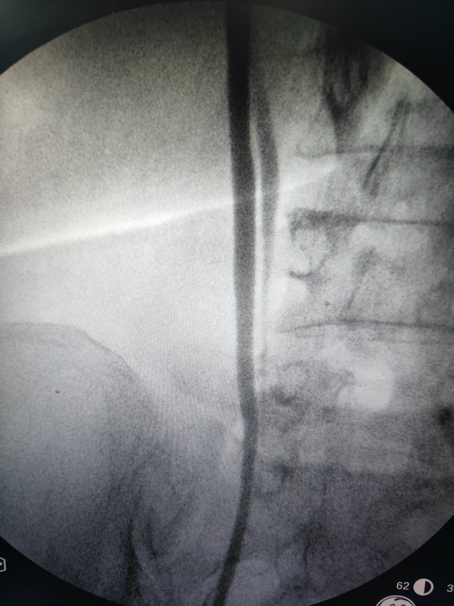 Eslam_wareth's tweet photo. Tips and tricks 🎯

You should make diagnosis first before make a decision 
When doing pcnl in duplex system 
With ureteric catheter in the wrong side 
Go back and get inside the true side with c.arm and contrast better 
#pcnl
#stones 
#urology
#surgery 
#tips_tricks
#anomalies https://t.co/g5rRkSTzXs