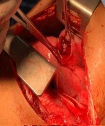 anatomie_x's tweet photo. Ein 22-Jähriger wurde in die Brust gestochen – das Messer blieb stecken. Im OP zeigte sich eine fast vollständig durchtrennte Lunge, die Spitze lag nur 2 cm vom Herzbeutel entfernt. Das Messer wurde entfernt, die Lunge vernäht. Nach 9 Tagen konnte er die Klinik verlassen. https://t.co/TdE8tF90Qn