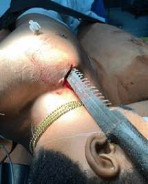 anatomie_x's tweet photo. Ein 22-Jähriger wurde in die Brust gestochen – das Messer blieb stecken. Im OP zeigte sich eine fast vollständig durchtrennte Lunge, die Spitze lag nur 2 cm vom Herzbeutel entfernt. Das Messer wurde entfernt, die Lunge vernäht. Nach 9 Tagen konnte er die Klinik verlassen. https://t.co/TdE8tF90Qn