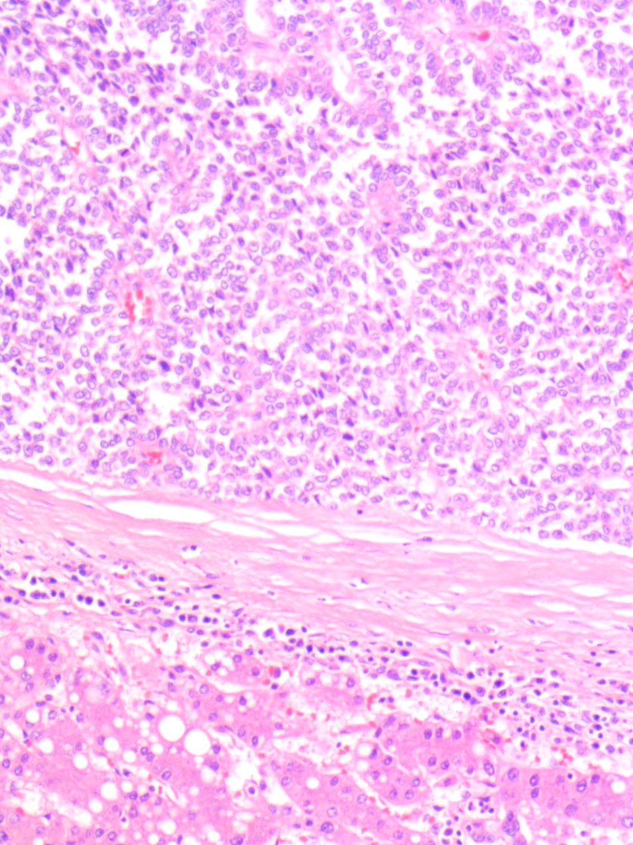 Rafat_abushakra's tweet photo. A 30 year old lady was found to have a large mass involving the right liver lobe / falciform ligament. Hepatic lobotomy was performed. 
What is your opinion?
#GIpath
#BSTpath
#PathX
#Pathology 
#Pathtwitter https://t.co/qkRVUMwozs