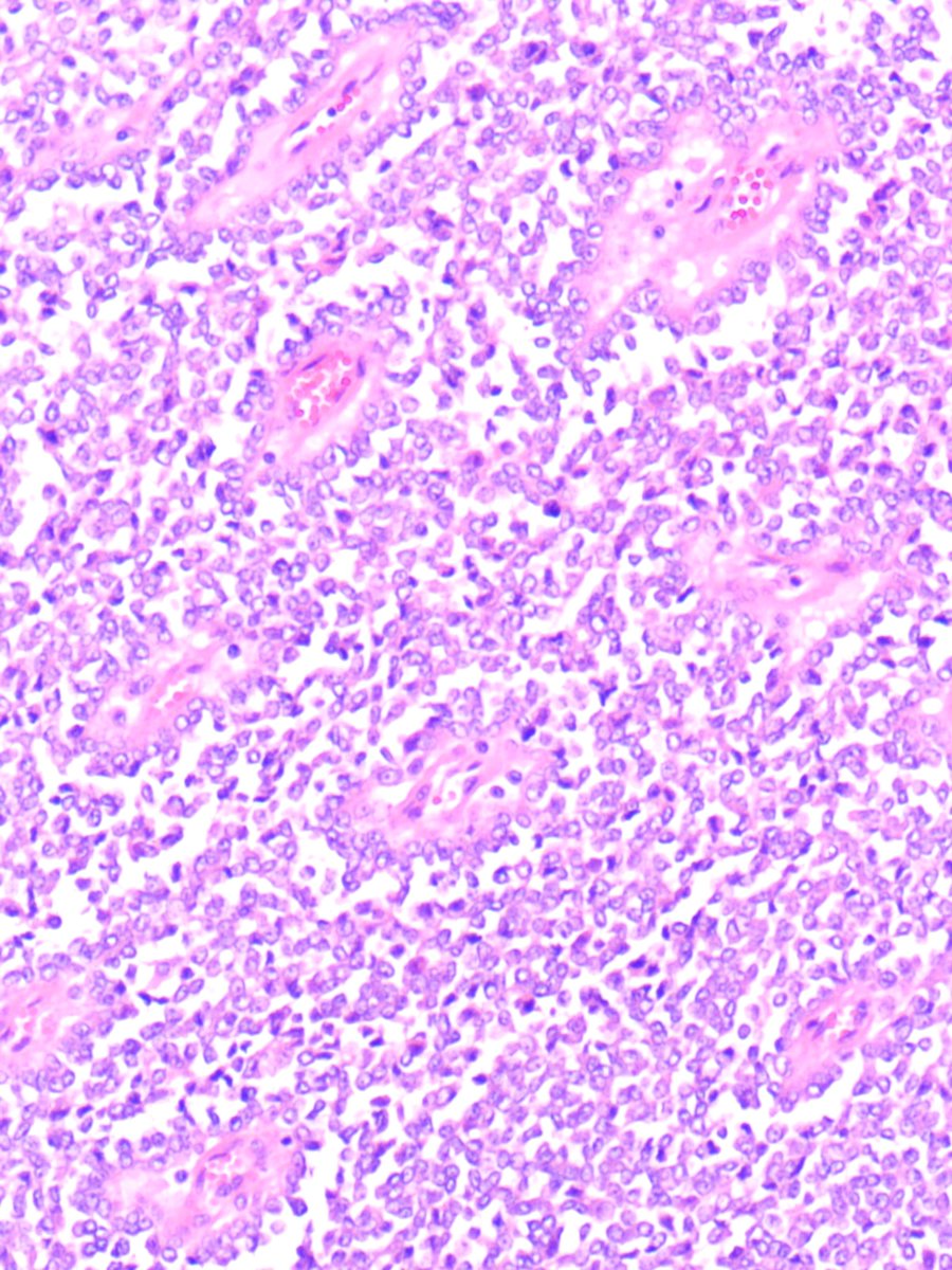 Rafat_abushakra's tweet photo. A 30 year old lady was found to have a large mass involving the right liver lobe / falciform ligament. Hepatic lobotomy was performed. 
What is your opinion?
#GIpath
#BSTpath
#PathX
#Pathology 
#Pathtwitter https://t.co/qkRVUMwozs