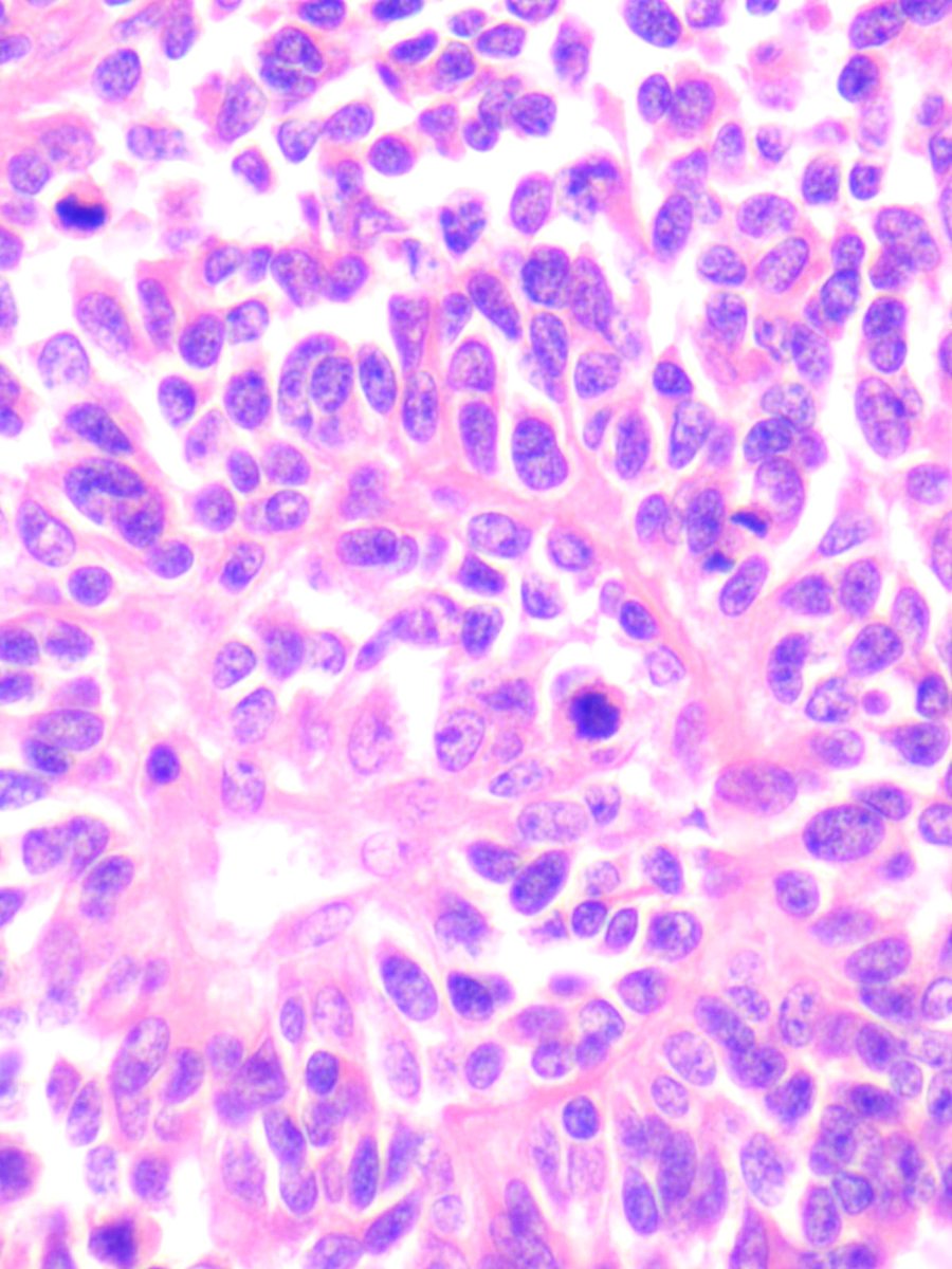 Rafat_abushakra's tweet photo. A 30 year old lady was found to have a large mass involving the right liver lobe / falciform ligament. Hepatic lobotomy was performed. 
What is your opinion?
#GIpath
#BSTpath
#PathX
#Pathology 
#Pathtwitter https://t.co/qkRVUMwozs