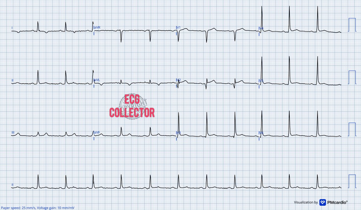DrRazi4's tweet photo. 40 y.o.gentleman active smoker; intermittent chest pain for past 3 days;
What do you think🤔❓
@PMcardioApp
#Cardiology
#ECG
#EKG
#CardioEd https://t.co/xhtiDHk0uG