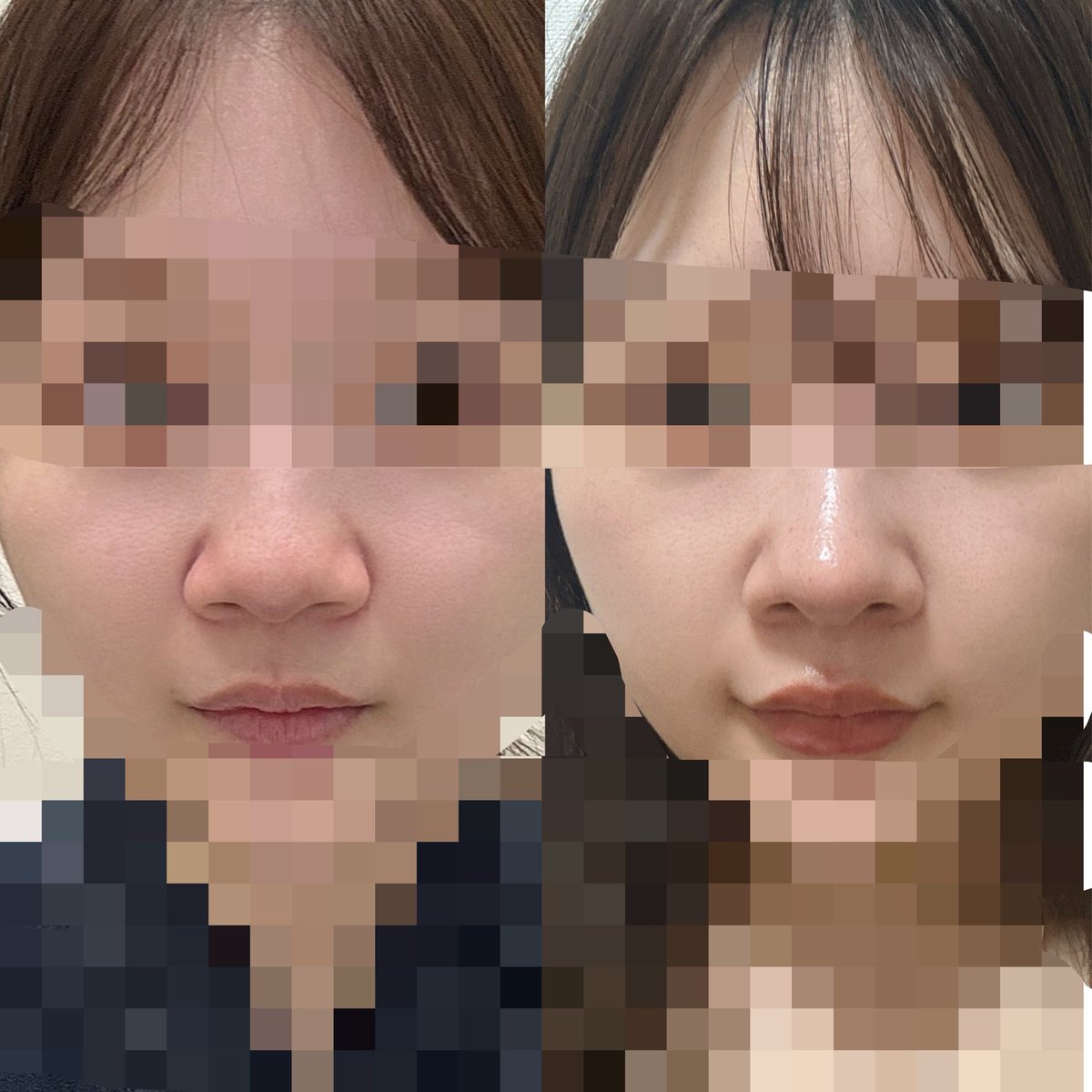 939859_'s tweet photo. 前からの印象を大きく変えたくなくて小鼻切りたくないって伝えたら全然いけるって言って貰えたのでそのままでお願いした😌横幅のサイズ感は変わらないけど鼻先が持ち上がったことでぼってり感が無くなって自然な変化で嬉しい🫢🤍前から見た形は満点💯
#鼻フル　#鼻整形　#韓国整形 https://t.co/PnnafDV7R5