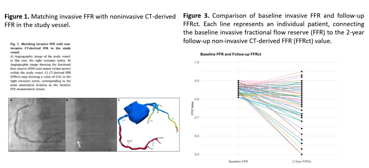 journalCCT's tweet photo. Can noninvasive follow-up identify progressing intermediate coronary lesions? Mahmoud et al. combined FFRct with AI plaque analysis and found lower follow-up physiology was associated with greater noncalcified and low-attenuation plaque burden. 

https://t.co/jon6sNio7D https://t.co/McThCMtHxV