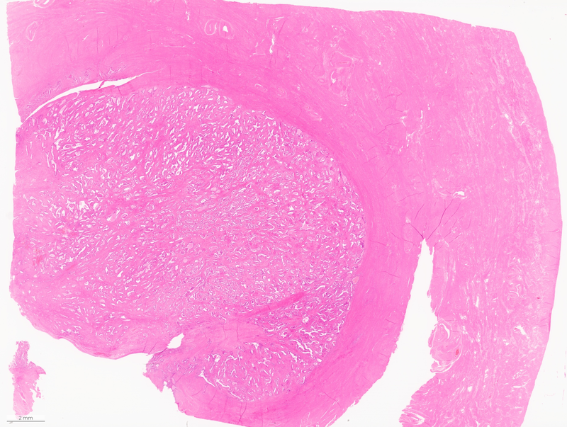 BAGPGynPath's tweet photo. BAGP Case of the Month 🔬

Not your average polyp! ✨

A 48-year-old woman presents with menorrhagia. An endometrial polyp is identified and she proceeds to hysterectomy + BSO.

Macroscopic: Cream, polypoid endometrial mass measuring 30mm, appearing to extend into the superficial myometrium.

🧠 Diagnosis next Friday!

#BAGPCaseoftheMonth #BAGPCotM #GynaePath #GynPath #PathTwitter #PathQuiz