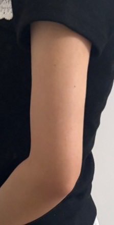 _o5913's tweet photo. ドクターマンゴー🥭@DrMango_Jp で脂肪吸引を受けて3ヶ月経ちました！

Before 1枚目　After 2.3枚目
今は痛みは全くなく腕は動かしやすいですが、拘縮予防として、一応毎日家でマッサージしてます！暑くなってきてキャミソールとか今までは着れなかったけど、今は色んな服が着れて楽しいです✨ https://t.co/xT6Jcvc7uD