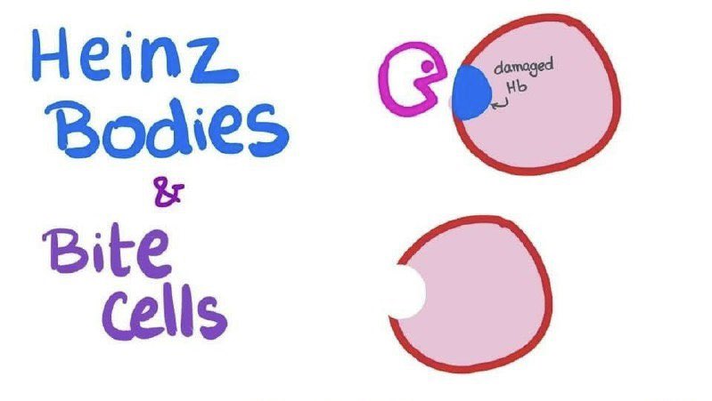 aarayyni's tweet photo. كيف تتشكلBite cells ؟

عندما يكون هناك نقص في انزيم G6PD يحدث ترسيب ل denaturate or oxidized Hb ويتشكل مايسمى ب Heinz bodies في خلية الدم الحمراء

وعندما تمر هالخليه عبر الطحال تقوم خلايا Macrophage  بقضم جزء منها فتصبح الخليه Bite cells .

#G6PD https://t.co/6CuhrfQwzm