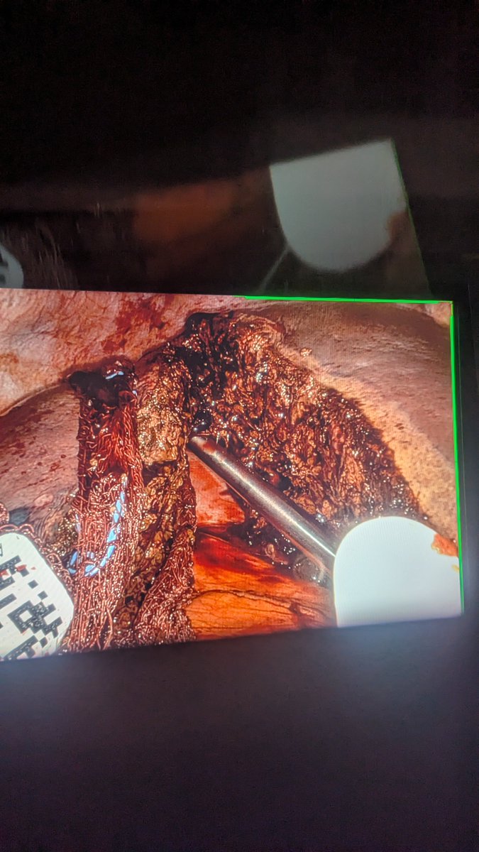 SurgOnc_Sam's tweet photo. Robotic Segment 5/6 partial resection for 7cm metastatic sbNET +chole + SBRsxn. Looping a sponge around transection line gives nice control. https://t.co/KYIYchSUmr