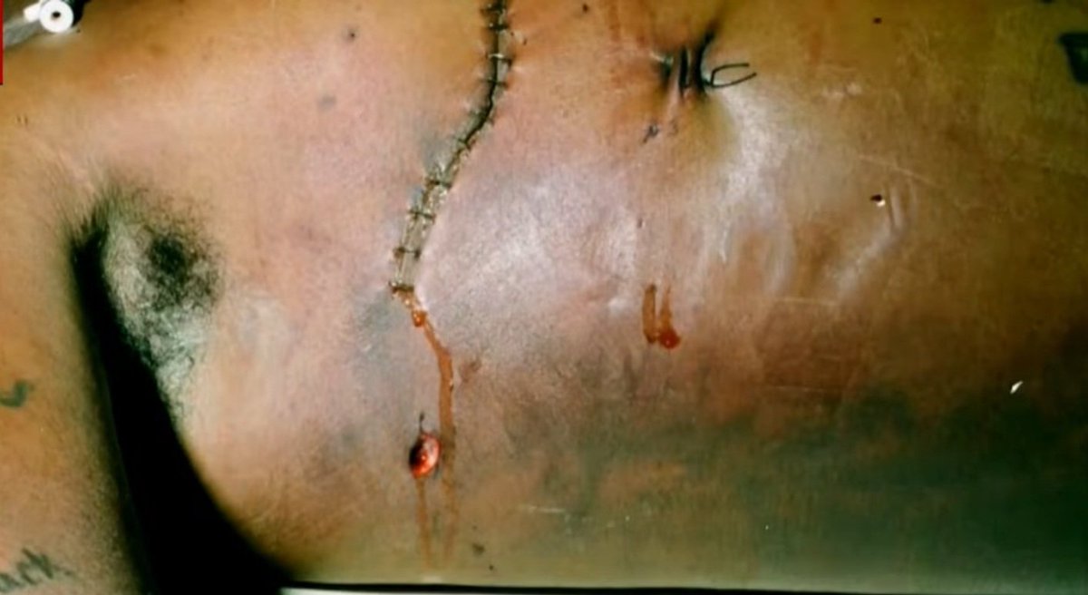 WeOutHereNews's tweet photo. 🚨🚨🚨  GRAPHIC WARNING

Never before seen photos of TUPAC SHAKUR AUTOPSY shown to jury during Keffe D's murder trial

Happened minutes ago https://t.co/DKhkyvHLfn