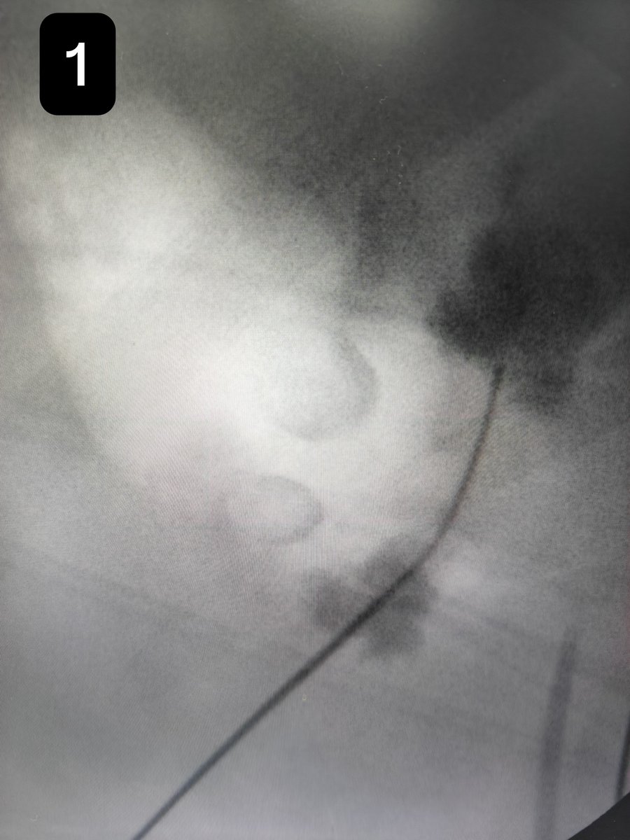 Eslam_wareth's tweet photo. Tips and tricks 🎯

Make sure from the wire to be inside the pelvicalyceal system 
Photo 1 you think it's inside 
Photo 2 after dye injection it's outside 
Don't do puncture untile be sure wire inside 
#pcnl 
#urology
#stones 
#tips_tricks
#Urologist https://t.co/7pkGpDuqd5