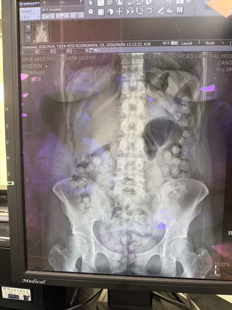 RonallChersan's tweet photo. 😱 ข่าวล่าสุด ตำรวจไต้หวันจับกุมหญิงไทยที่สนามบินนานาชาติเกาสง หลังพบกลืนแคปซูลเฮโรอีน 72 เม็ด มูลค่าประมาณ 3.6 ล้านเหรียญไต้หวันเพื่อลักลอบขนยาเข้าไต้หวัน

🔴เจ้าหน้าที่นำตัวส่งโรงพยาบาล ให้ยาเพื่อช่วยให้ขับถ่ายยาเสพติดออกมาตามธรรมชาติ ใช้เวลานานถึง 10 วัน จึงสามารถขับถ่ายยาเสพติดออกจากร่างกายได้หมด 

🔴หญิงคนนี้มีอาชีพเป็นครูสอนมวยไทย มีพละกำลังและสมรรถภาพทางร่างกายเหนือกว่าคนทั่วไป เจ้าหน้าที่ชุดปฏิบัติการจึงต้องเฝ้าระวังและควบคุมดูแลอย่างใกล้ชิดตลอด 24 ชั่วโมง