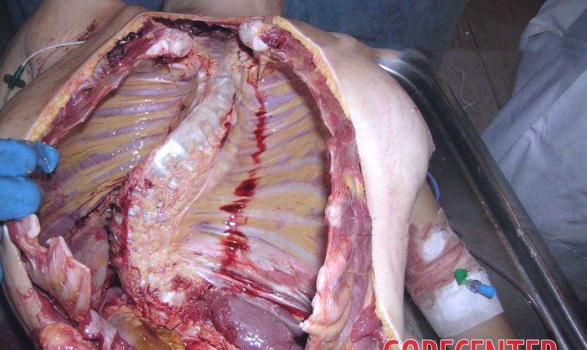moriitician's tweet photo. an example of scoliosis in an autopsy.
ai generated / sfx art https://t.co/NE5tKhxzGk