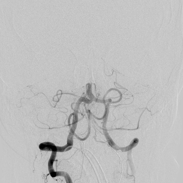 daviibarbosa_'s tweet photo. Direct Aspiration (DA) or Stent Retriever (SR) for acute BAO? 🩸

The usual answer in the neuro-suite is "operator preference". But when you pool 1,851 patients across 14 studies, a clear safety gap emerges. 

Here is the bottom line from our updated Meta-Analysis:

- DA takes the lead. It showed a significantly lower risk of symptomatic intracranial hemorrhage (sICH).

- A dead heat. No significant difference in 90-day functional outcomes or mortality. 

This is the hard safety data you want in your back pocket when selecting your first-line device.

Massive kudos to Wei Jun Lee, MD (@Dylon_WJLee) for leading this effort! 

🔗 Dive into the full paper in @ESNRad @NRADjournal: https://t.co/dNnWotEOph

@metaacademy_ofc 

👇 Is DA your default go-to, or do you still reach for the SR first? 
Let’s debate.

#MedX #NeuroTwitter #Stroke #NeuroIntervention
