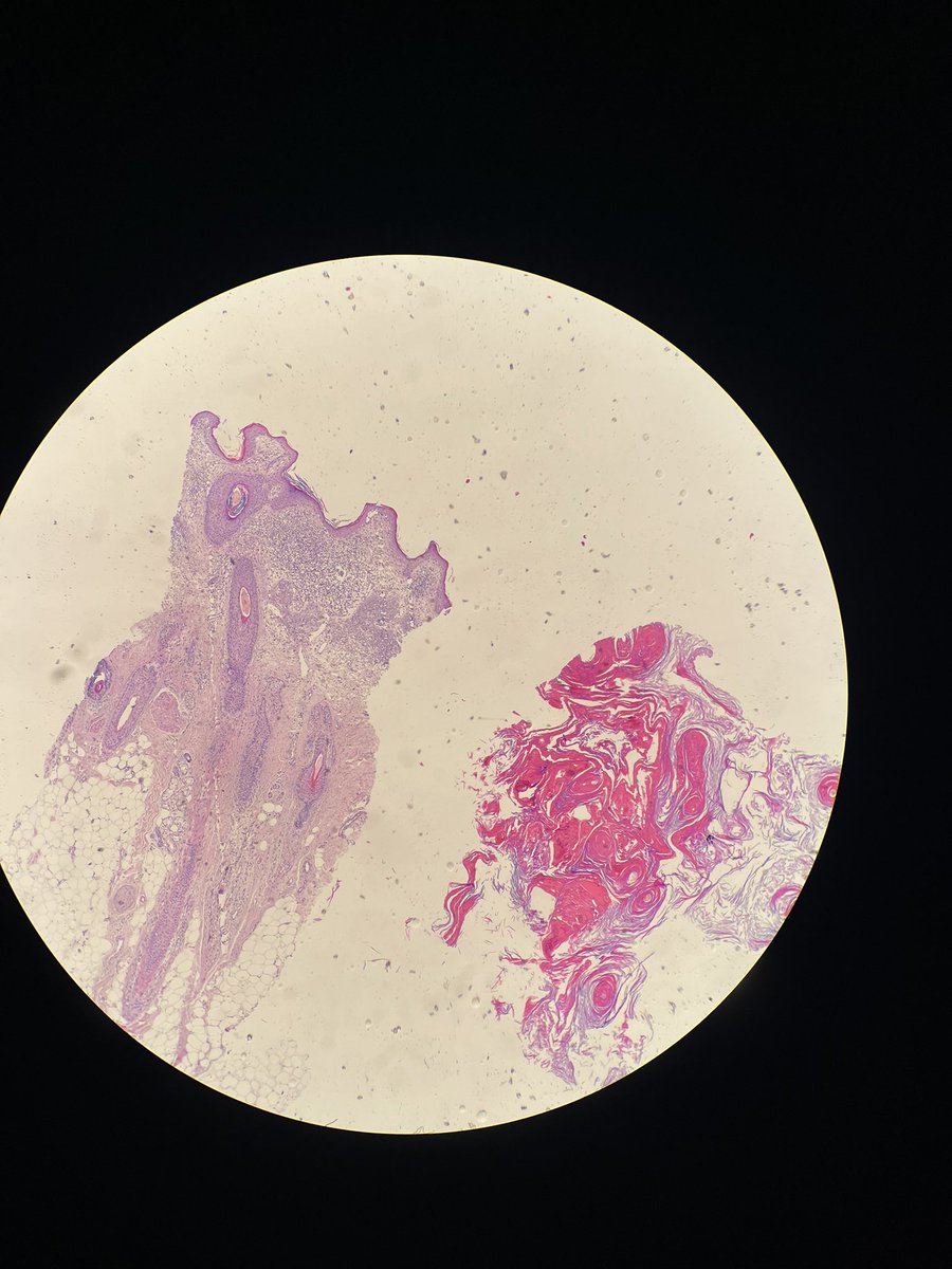 drtugcecay's tweet photo. Scalp punch biopsy. What is your differential diagnosis? #dermpath #pathx #pathtweet #pathology https://t.co/oyOzD9TQOw