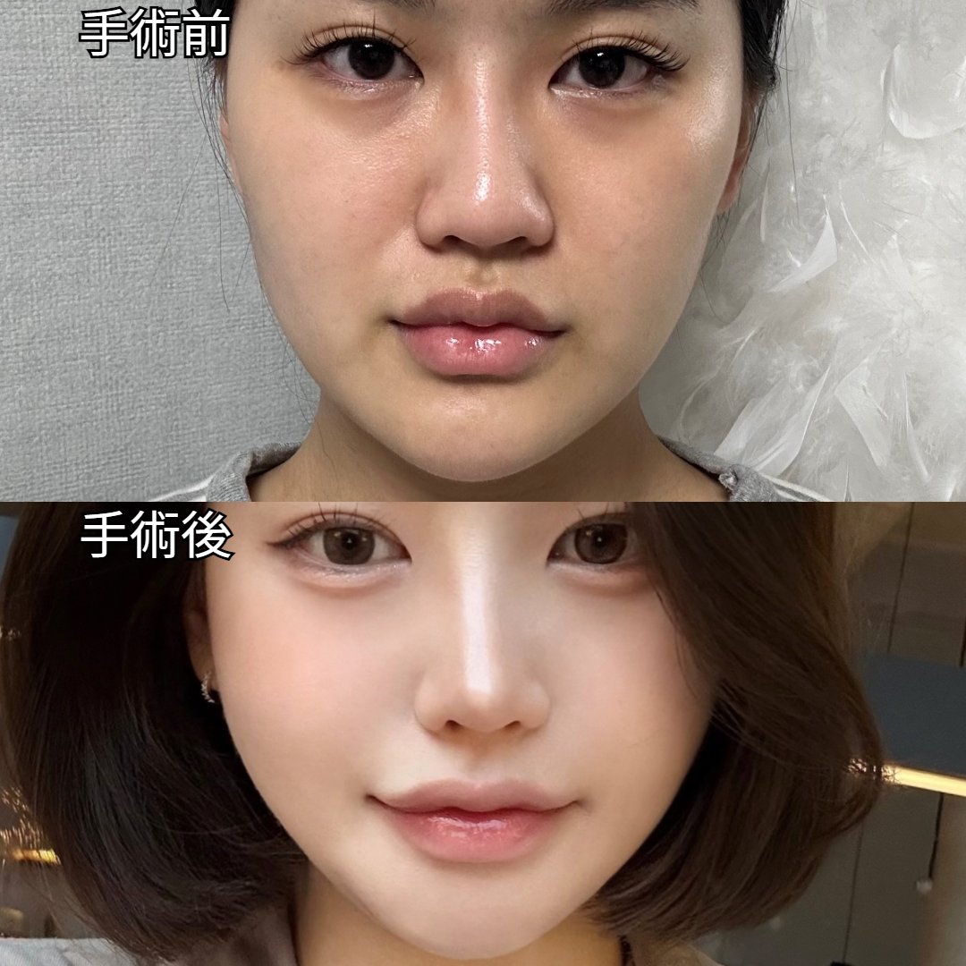 Lachal_JP's tweet photo. この方は顔のコンプレックスのせいでかなり落ち込んでいると訴えていました
輪郭整形をメインに、目と鼻を顔の形に合わせて直したら、まるで生まれ変わったような感覚だと言われています

＃韓国整形
＃美容外科
＃鼻整形
＃輪郭3点
＃目整形

申し込みはこちらえ！
🔻🔻🔻
https://t.co/hPZMgQeQbK https://t.co/mP6DIgZTeT