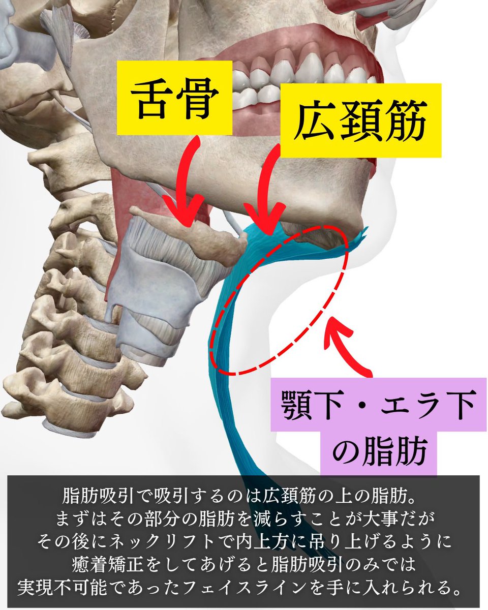 dr_miyata_'s tweet photo. おすすめは『ネックリフト』です👈🏻

脂肪をなくしただけでは、
"内側へ引き込む力"は働きません🙅🏼‍♂️

脂肪を無くした後に
糸リフトを用いた『ネックリフト』で

筋肉、舌骨ごと内側にグッと引き込むと

ピタッとした理想のフェイスラインを作り出せます👌🏻 https://t.co/Q55TInxQwX