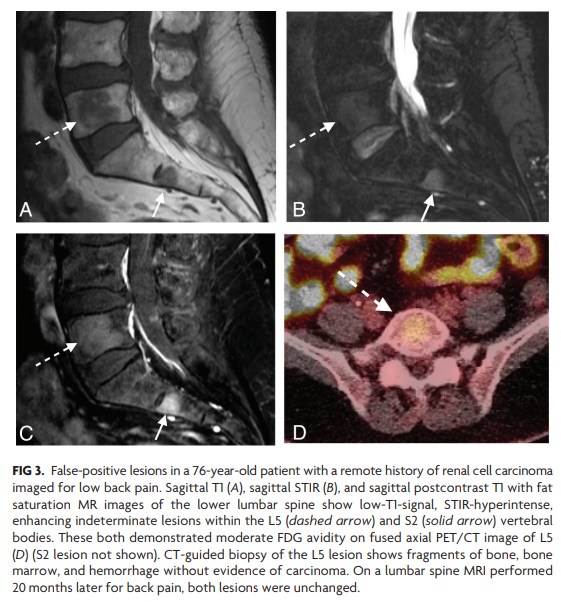 TheAJNR's tweet photo. "Indeterminate T1-Hypointense Spine Lesions: Prevalence of Malignancy in the Absence of Aggressive Imaging Features"

https://t.co/M7akjlJJPA https://t.co/wJgR7buGC6