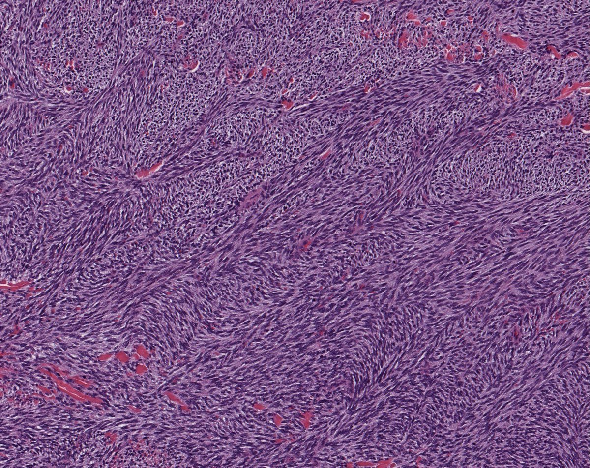 JMGardnerMD's tweet photo. Large soft tissue mass in leg of NF1 patient. Multiple mitoses. S100 negative.
Answer ✅ https://t.co/vw2bQY9GMG
Name of the pattern & list of other tumors that can have it ➡️ https://t.co/5nmTYEGTer.
#BSTpath #pathologists #pathology #pathTwitter #dermpath https://t.co/s4aZA04bN8