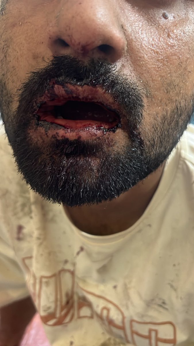 DevendraSRana's tweet photo. एडीजी मेरठ जोन, कृपया ध्यान दें!
@adgzonemeerut
बुलंदशहर के थाना नरसैना में निष्पक्ष जांच पर सवाल

ग्राम चंदियाना में 15/08/2026 को दोपहर करीब 3 बजे खूनी मारपीट हुई।

FIR 0208 (17/08) -शान अहमद (यूसुफ) बनाम इरफान (नियमतुल्ला), फरहान, दानिश, फैसल, साकिब व जैद। घायल: खुशहान (मेरठ मेडिकल में गंभीर), शान व उनकी पत्नी।

FIR 0210 (19/08) - फैसल (इरफान) बनाम शान अहमद, शादान व खुशहान। घायल: फरहान, जिसके चेहरे पर चाकू लगने से टांके आए।

गांव में पुलिस की निष्पक्षता को लेकर गंभीर सवाल उठ रहे हैं और एक पक्ष द्वारा पुलिस पर प्रभाव डालने के आरोप लगाए जा रहे हैं।

मामले की निष्पक्षता सुनिश्चित करने के लिए जांच किसी अन्य थाने अथवा क्राइम ब्रांच से कराई जाए।

“जो ज्यादा पैसे देगा वही जीतेगा” वाली भ्रष्ट व्यवस्था खत्म होनी चाहिए।

#Bulandshahr #Narsena #PoliceCorruption #ADGMeerutZone
@UPGovt
@ChiefSecyUP @CMOfficeUP @dgpup @Rajeevkrishna69  @digrangemeerut @bulandshahrpol @dmbulandshahr @India_NHRC