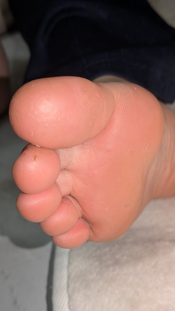 mjtagwj's tweet photo. 【木酢液】臭いけど液体窒素より治ります！
3年増えたのが1ヶ月で完治しました！
#ウイルス性イボ
#ヒトパピローマウイルス　#液体窒素　#イボ
#木酢液 https://t.co/pj1gwDVT8O