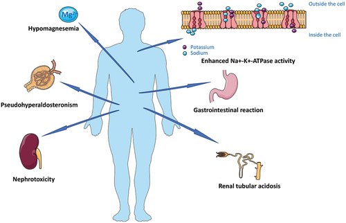 drsthanus's tweet photo. Piperacillin–tazobactam and Hypokalemia.

A patient on piperacillin-tazobactam can develop progressive hypokalemia because the drug acts as a non-reabsorbable anion. 

The high sodium load from the penicillin formulation increases distal tubular fluid flow and electronegativity, which drives profound renal potassium wasting that resists standard repletion until the antibiotic is stopped.

The patient is experiencing piperacillin-tazobactam-induced renal potassium wasting, a phenomenon driven by the chemical and pharmacological properties of the antibiotic. 

When this occurs, aggressive potassium replacement often fails to normalize serum levels because the kidneys continue to actively excrete the supplementary potassium.

*Associated Clinical Presentation.

Because hydrogen ions (H⁺) are excreted alongside potassium to neutralize the negative electrical charge in the urine, patients with this condition classically develop hypokalemic metabolic alkalosis.

**Clinical Management Steps.

1. Check Magnesium Levels: 

Always check and aggressively correct the patient's serum magnesium first. 

Concomitant hypomagnesemia opens renal outer medullary potassium (ROMK) channels, allowing unchecked potassium wasting and rendering potassium replacement completely ineffective.

2. Consider Drug Discontinuation: 

If the hypokalemia is severe, progressive, or causing ECG changes, discontinue piperacillin-tazobactam. 

The tubular dysfunction is completely reversible; once the drug is stopped, serum potassium levels typically normalize rapidly within 24 to 48 hours.

3. Switch Antibiotic Therapy: 

Transition the patient to an alternative broad-spectrum agent with a lower risk of renal anion-wasting, such as a carbapenem or cefepime, depending on culture and sensitivity data.

●The diverse pathophysiological mechanisms and system-wide adverse effects associated with drug-induced hypokalemia
https://t.co/gIztXAYRcc
