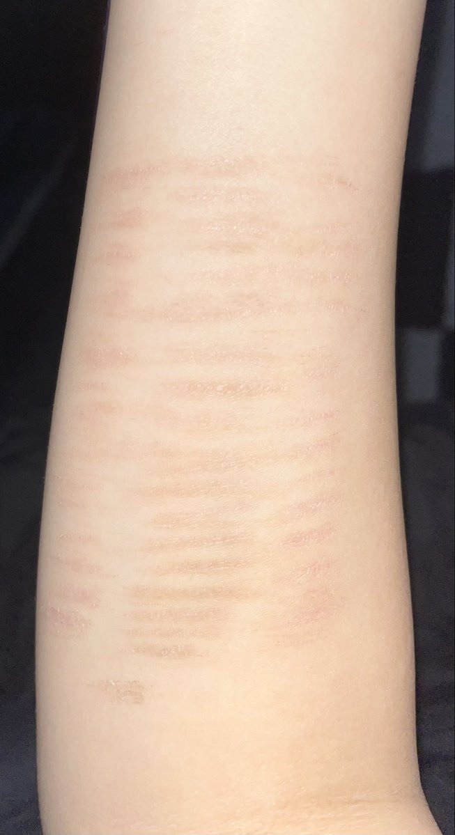 meowvfvv's tweet photo. IM SO FAWKING ANGRY MY SCARS ARE SO UGLY 🤬🤬 https://t.co/byD2TectKd