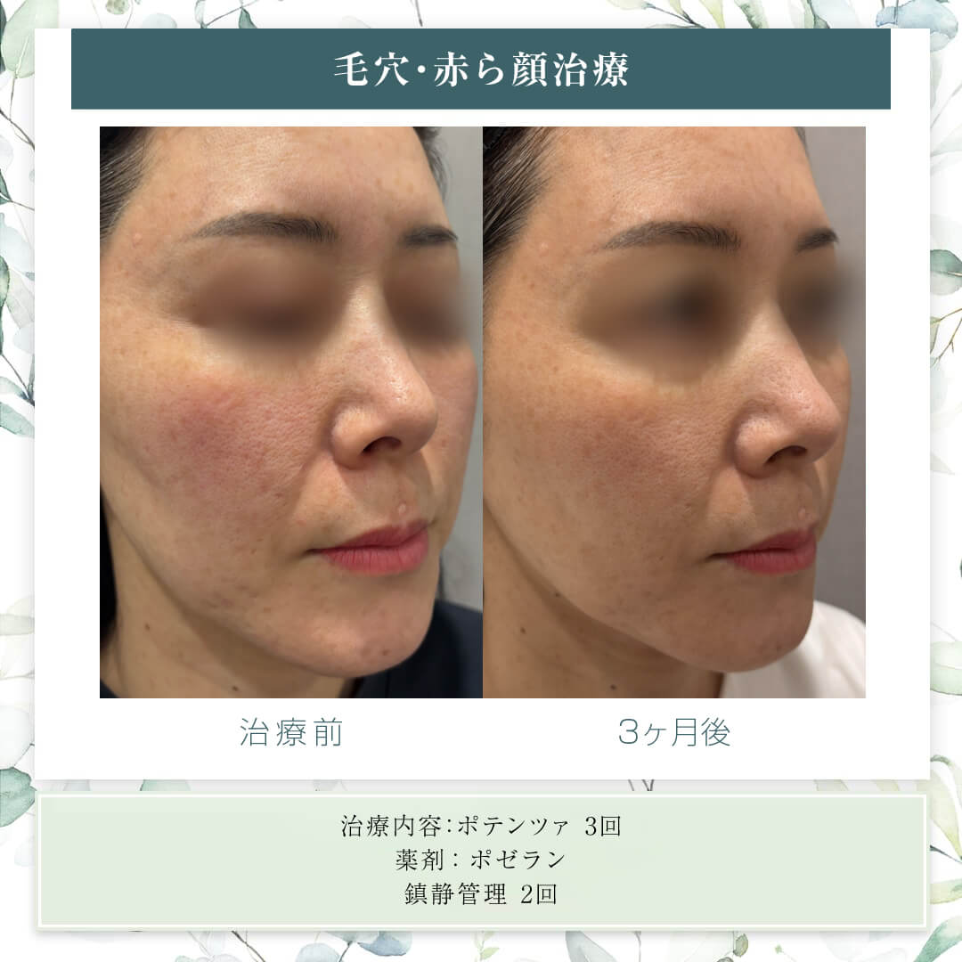 oracleclinic's tweet photo. #ニキビ跡の凹み 治療のために
ジュベルックポテンツァしてない？

#ジュベルック は凹みや赤みに効果的ですが
同時にシコリのリスクも💭

#ポゼラン ならシコリリスクを抑えながら
ニキビ跡の凹み・毛穴・赤み・酒さに効果的✨

只今30%OFFモニター募集中🎉
ポゼランとはhttps://t.co/kYuUxhCzW0 https://t.co/bneqozpfTQ
