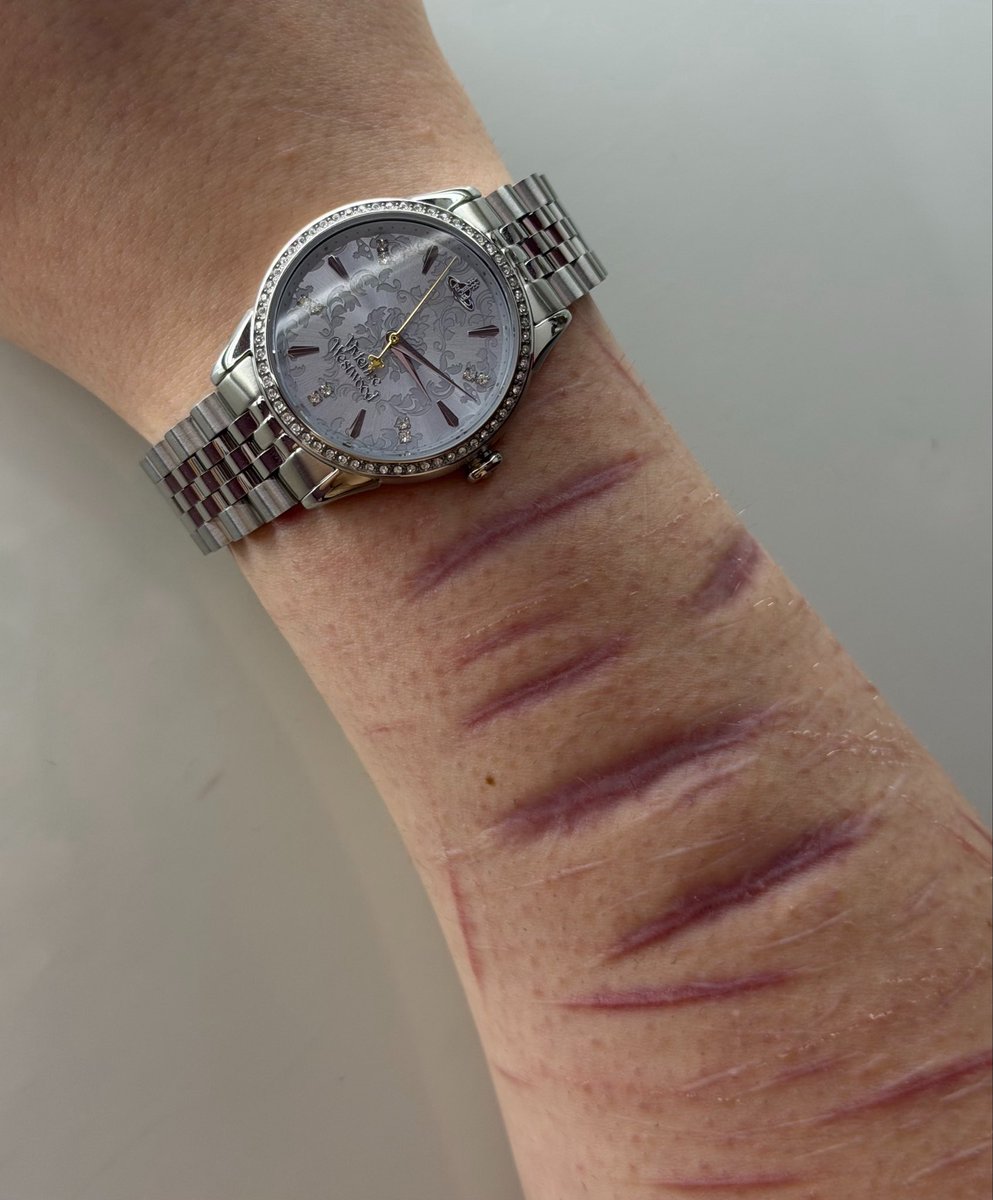 expl0sivecake's tweet photo. Do you guys like my new watch?👀🩷
#FAKE #scars #shtwt #slittwt https://t.co/8DJw026dvD