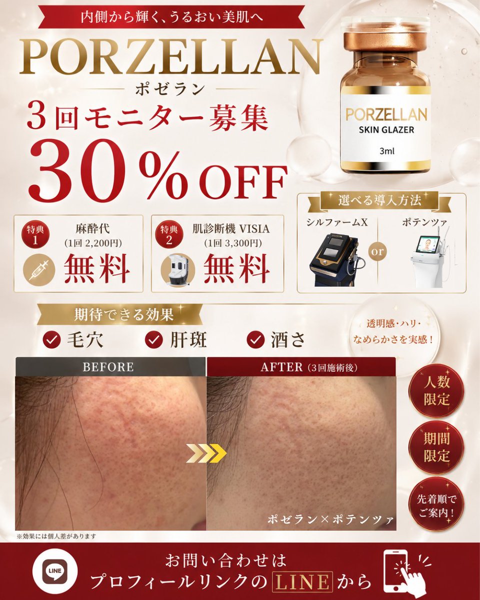 oracleclinic's tweet photo. #ニキビ跡の凹み 治療のために
ジュベルックポテンツァしてない？

#ジュベルック は凹みや赤みに効果的ですが
同時にシコリのリスクも💭

#ポゼラン ならシコリリスクを抑えながら
ニキビ跡の凹み・毛穴・赤み・酒さに効果的✨

只今30%OFFモニター募集中🎉
ポゼランとはhttps://t.co/kYuUxhCzW0 https://t.co/bneqozpfTQ