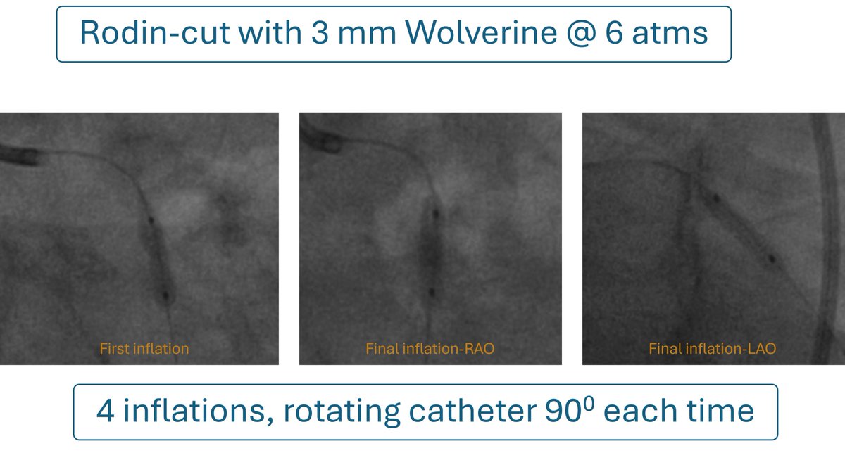 GopalKkoduru's tweet photo. #cardioTwitter #MedTwitter
@JACCJournals @ESC_Journals #CardioEd #Cardiology #PCI #DCBPCI Rodin-cut > index of Device Efficiency (IDE) https://t.co/bIRo81ijSL