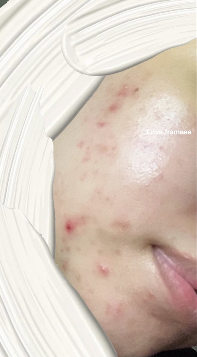 Loveframeee's tweet photo. Maaf syakap… memang MELAMPAU eh 2 produk ni?!! 😭 Kenapa buat skin aku jadi macam niii?? https://t.co/HbbK89L6xr