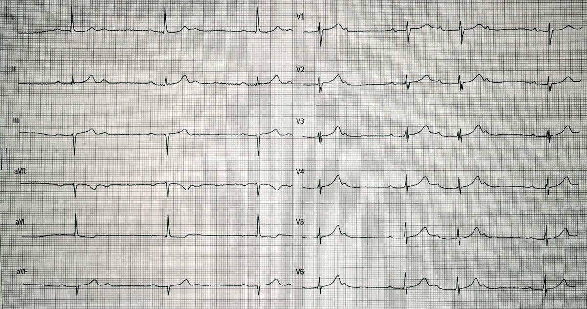 OnlyEcg1's tweet photo. Rhythm Dx?
#Cardiovascular #MedicalStudents #MedicalEmergency #Epeeps #EPeeps_bot #MedTwitter #Cardiology #CardioEd #EKG #ECG #Paramedics #MedicalEducation #EPS #MedicalCase #MedicalQuiz #Cardiologist #CardioTwitter https://t.co/diANU6sefj