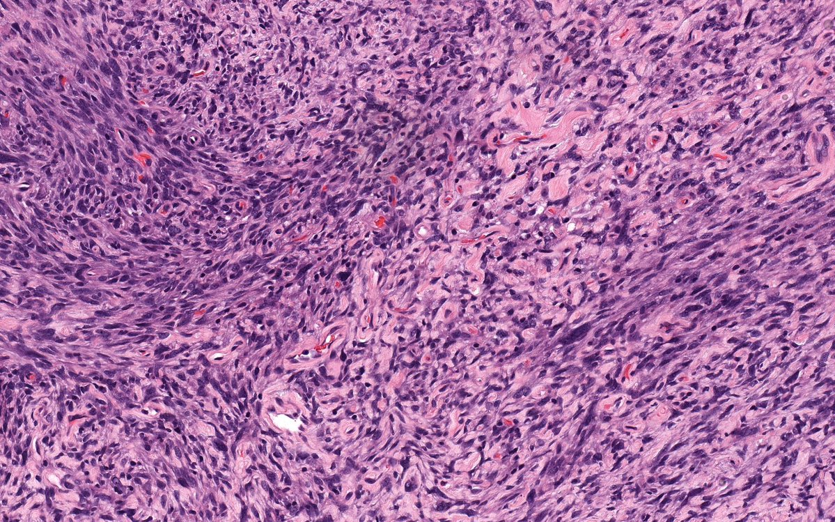 JMGardnerMD's tweet photo. 9 yo F. Back nodule. Clinical dx: lipoma vs cyst.
Answer ✅ https://t.co/tGzM3HrC2d
WSI digital slides: https://t.co/fCiNctDuHf
Stains: https://t.co/j2n8z6erPX
#pathology #pathologists #pathTwitter #dermpath #dermatology #dermatologia #dermtwitter #BSTpath https://t.co/aUgbzjy63h