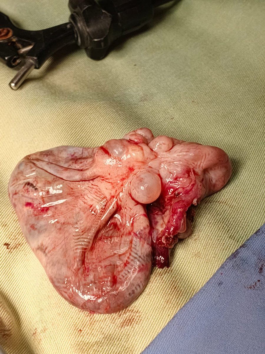 MedZubair's tweet photo. This is Case of hemorrhagic Cyst present in left fallopian tube in 37 years female Surgeon removed one side ovary,cyst,Fallopian tube and round ligament NRE #USMLE #AMC #PLAB #Pediatrics #Neonatology #MedTwitter #MedicalEducation #FOAMed
Follow for more Medical points @MedZubair https://t.co/7bTWLsCEU0
