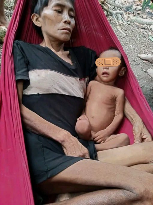 ReporteYa's tweet photo. #20Ago #Amazonas 
@Fritz_A_Sanchez: 🚨 Emergencia en Alto Orinoco         
Indígenas en estado Crítico   

El capitán indígena yanomami Eliseo Silva denuncia la crítica situación de salud de varios hermanos indígenas del municipio Alto Orinoco, quienes requieren ser trasladados con urgencia a Puerto Ayacucho.

El líder indígena advierte que llevan casi un mes esperando apoyo para el traslado, mientras en la región ya escasean los insumos médicos y no existen condiciones adecuadas para atender a los pacientes  

Hace un llamado a las autoridades nacionales, regionales y municipales a actuar de inmediato. La salud y la vida de estas comunidades indígenas no pueden seguir esperando...