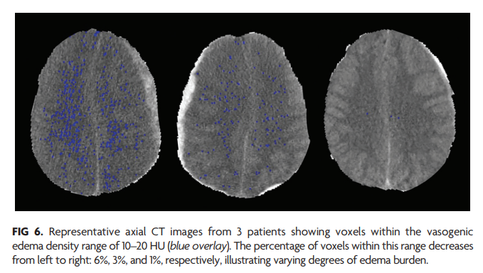 TheAJNR's tweet photo. "CT-Based Assessment of Brain Edema May Predict Which Patients with Traumatic Brain Injury May Benefit from Tranexamic Acid"

https://t.co/tNKYSbH575

@theAJNR_EIC https://t.co/ohOT9CuD5C