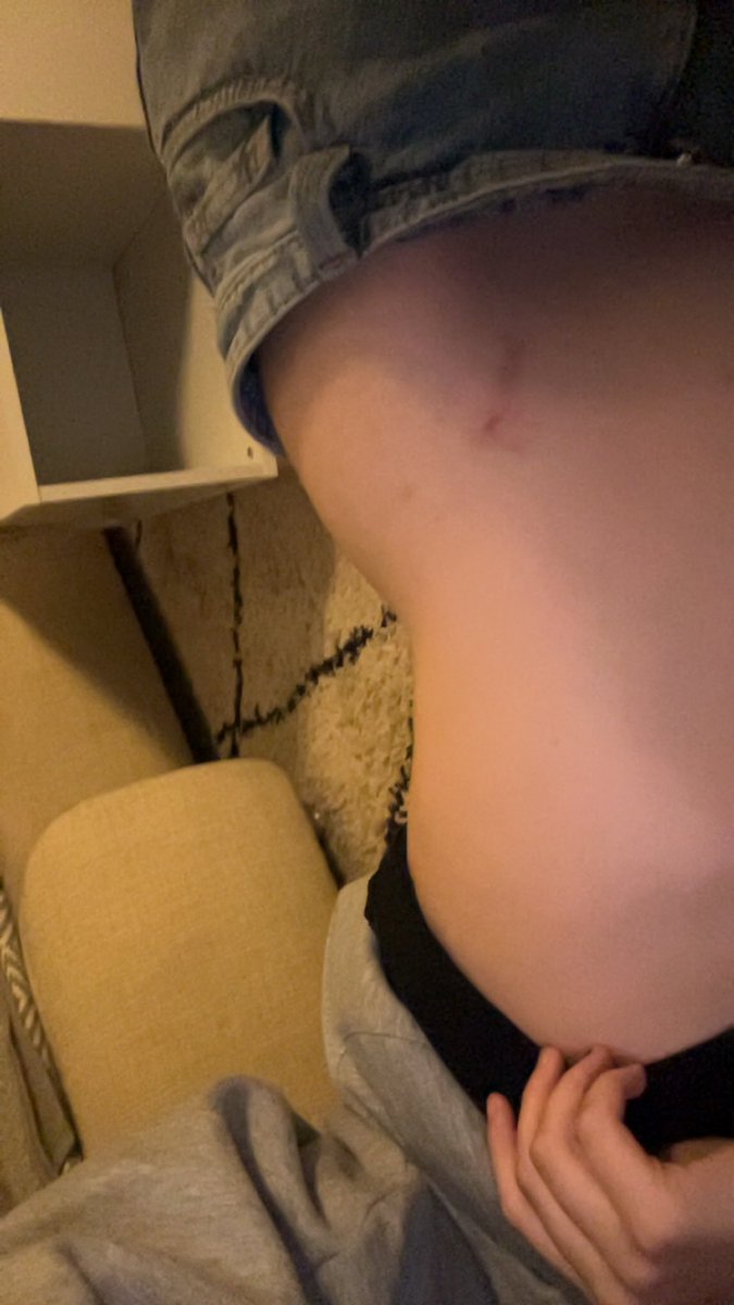mimiipawzz's tweet photo. I somehow really like my surgery scar.
#edtwt #ED #ed #cat https://t.co/y7Hg9rE5v2